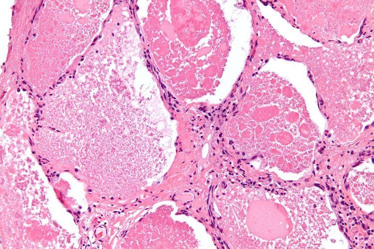 Pulmonary alveolar proteinosis