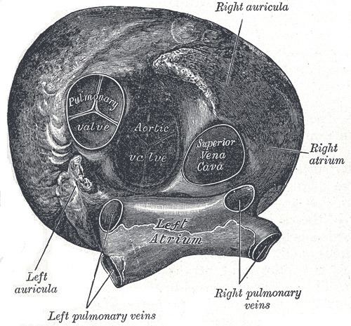 Pulmonary atresia