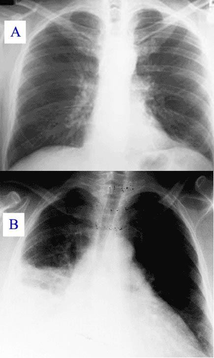 Pulmonary consolidation