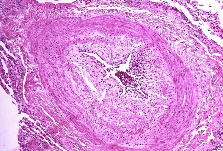 Pulmonary hypertension