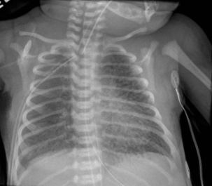 Pulmonary interstitial emphysema