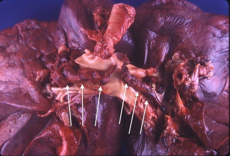 Pulmonary thrombectomy