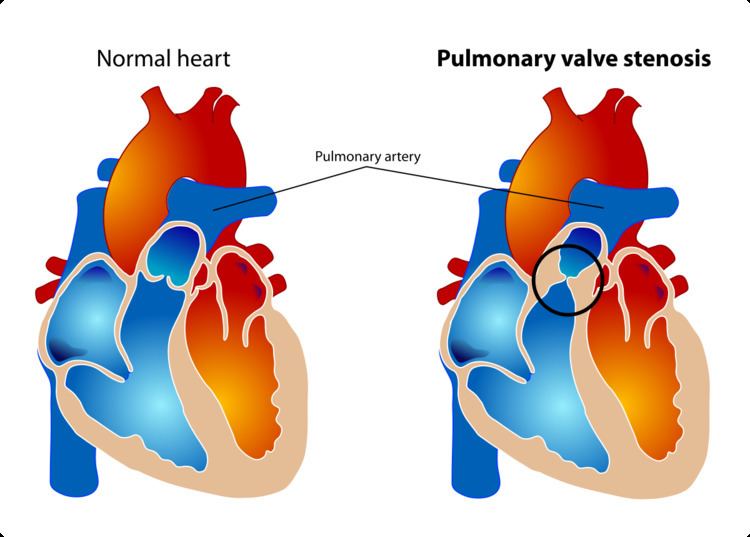Pulmonary valve stenosis