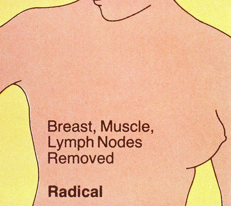 Radical mastectomy