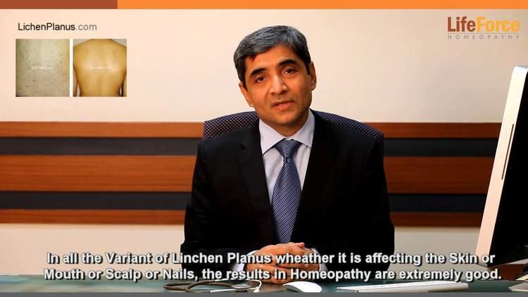 Rajesh Shah Lichen Planus and its homeopathic treatment explained by Dr Rajesh