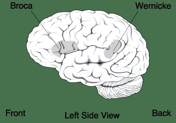 Receptive aphasia