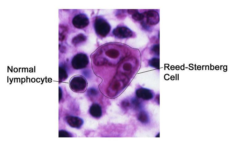 Reed–Sternberg cell