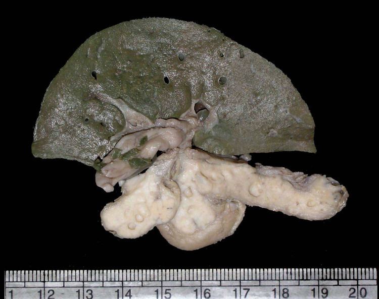 Renal-hepatic-pancreatic dysplasia