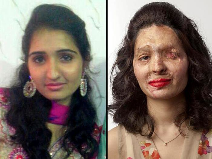Reshma Qureshi Acid attack survivor Reshma Qureshi will walk at New York Fashion