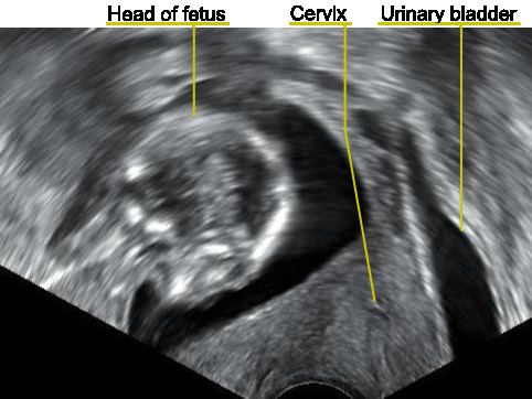 Retroverted uterus