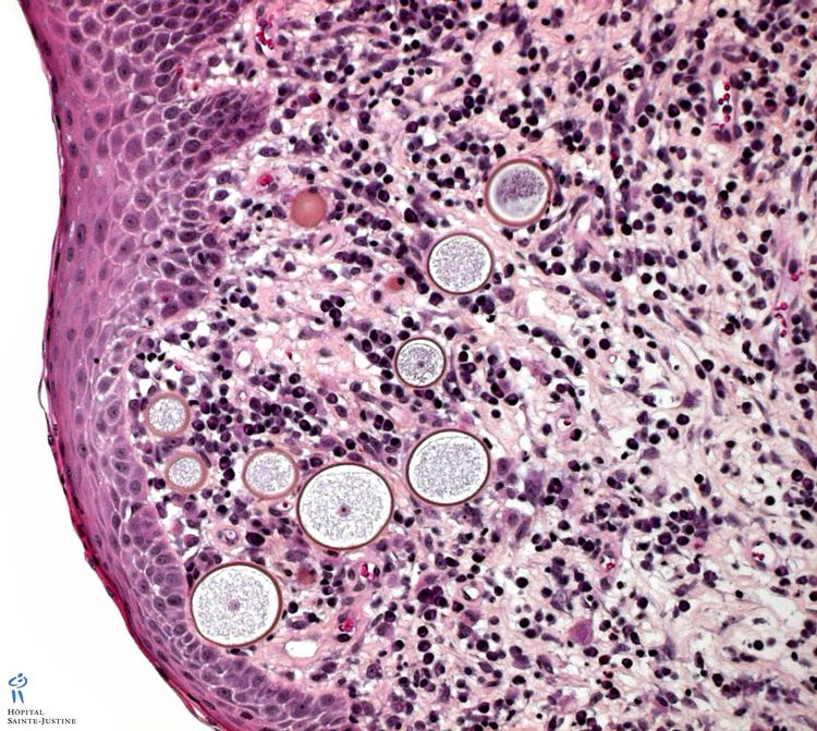 Rhinosporidium seeberi Rhinosporidium seeberi Humpathcom Human pathology