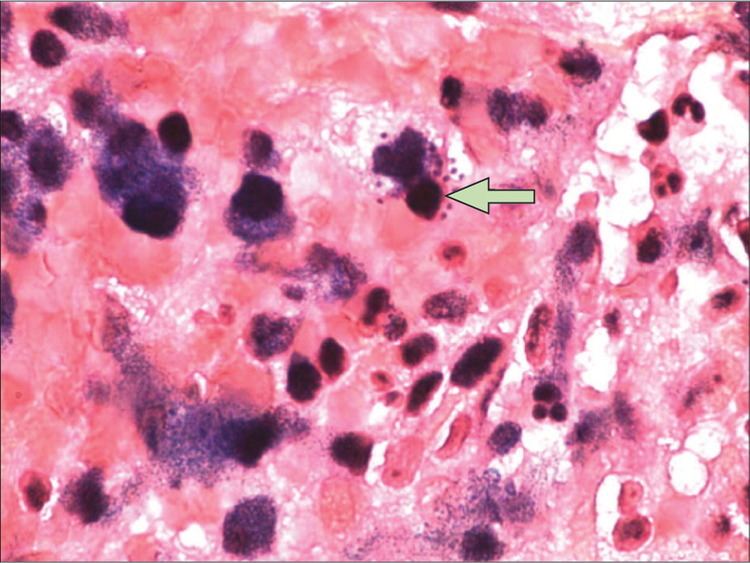 Rhodococcus equi Rhodococcus equi infection The Lancet Infectious Diseases