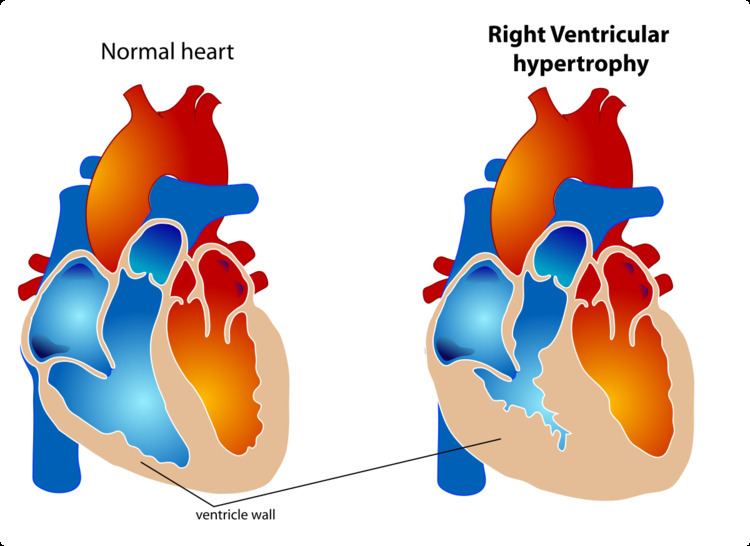 Right ventricular hypertrophy