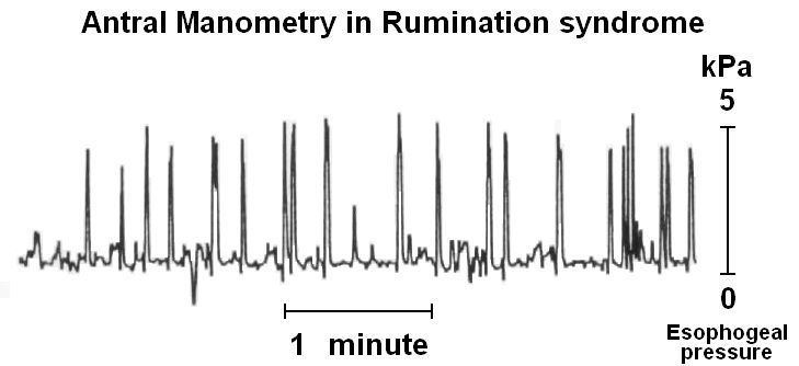 Rumination syndrome