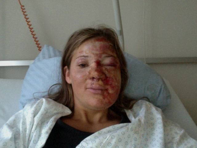 Sara Hector lying on a hospital bed, with bruises all over her face,  wearing a white hospital gown and black shirt.