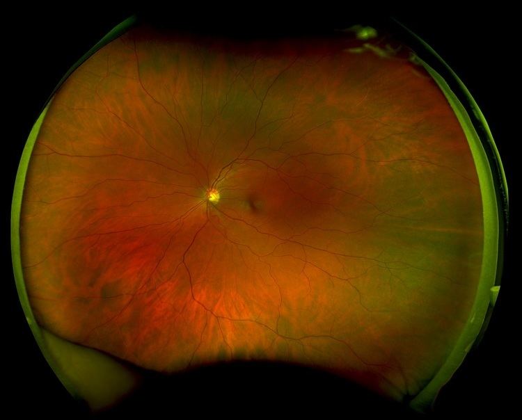 Scanning laser ophthalmoscopy