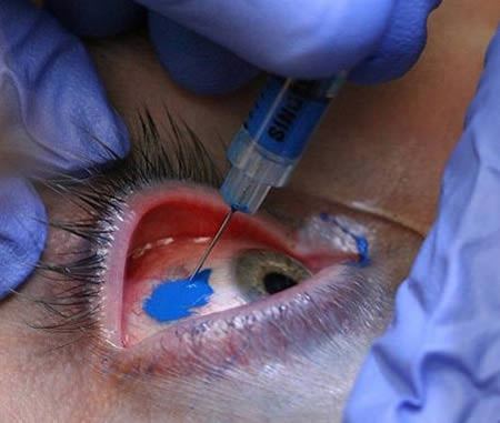 Scleral tattooing
