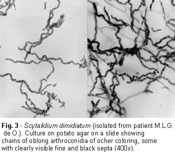 Scytalidium Onychomycosis caused by Scytalidium dimidiatum Report of two cases