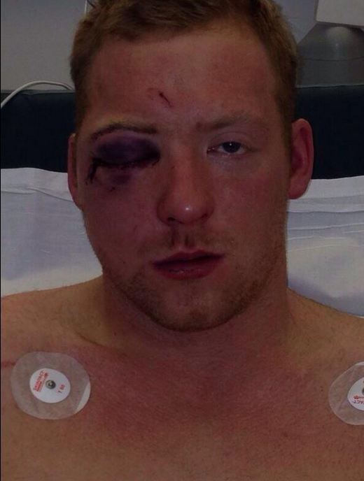 Sean Gleeson Sean Gleeson eye injury picture Pictured Horrific eye