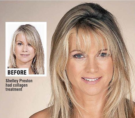 Shelley Preston smiling and with blonde hair on a comparison photo before and after she had a collagen treatment.