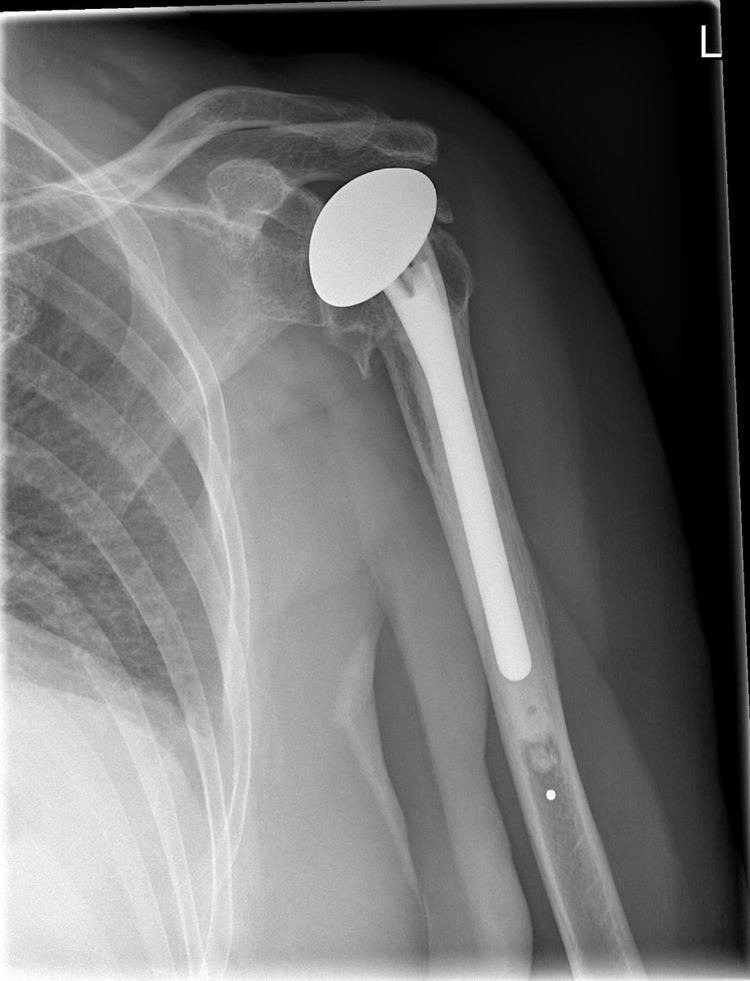 Shoulder replacement