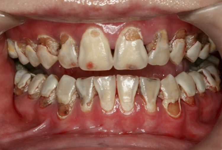 Silver diammine fluoride Clinical Use of Silver Diamine Fluoride in Dental Treatment