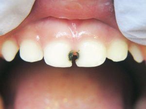 Silver diammine fluoride Silver Diamine Fluoride Growing Smiles Pediatric Dentistry