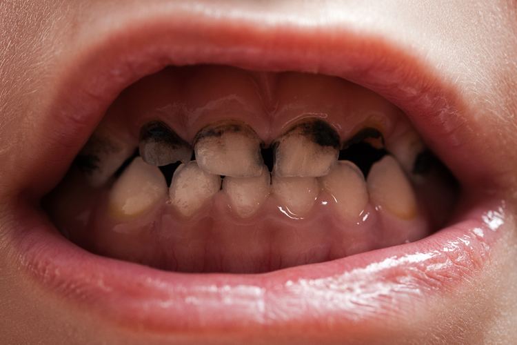 Silver diammine fluoride Trial shows biannual application of silver diamine fluoride better