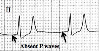 Sinoventricular conduction - Alchetron, the free social encyclopedia