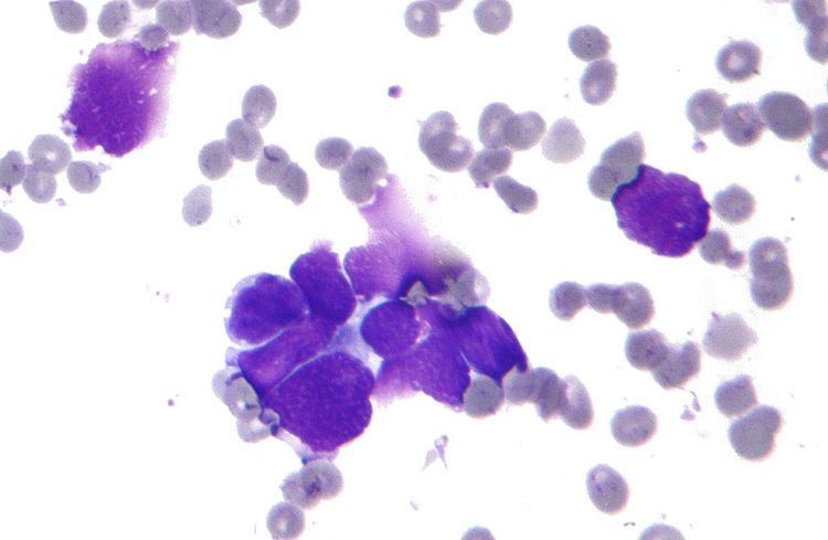 Small-cell carcinoma
