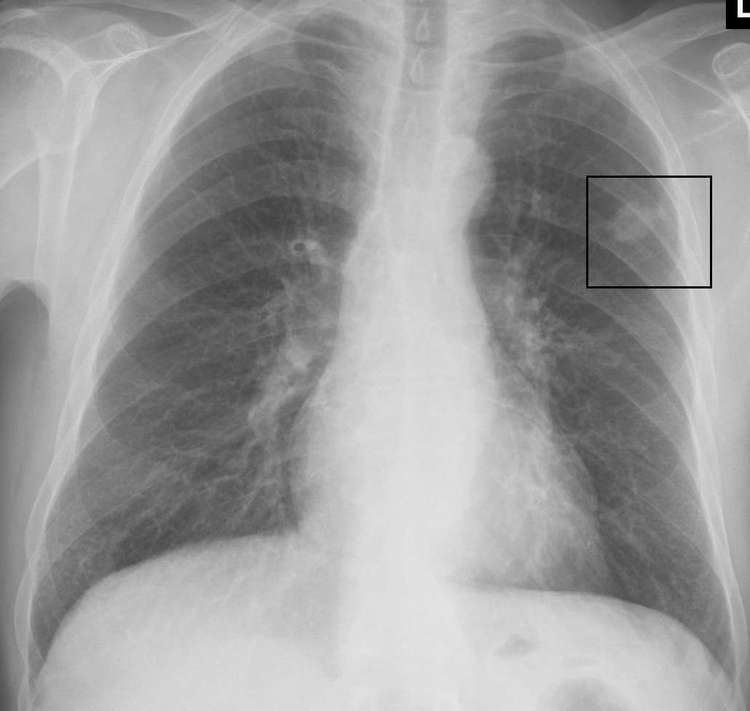 Solitary pulmonary nodule
