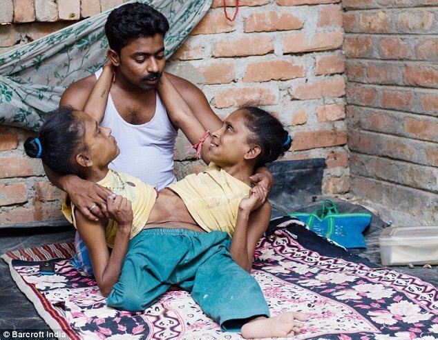 Indian conjoined twins, 45, find love with the same man | Daily Mail Online