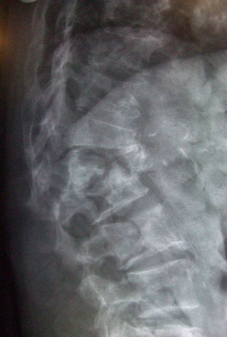 Spinal fracture