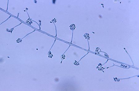 Sporothrix schenckii Sporotrichosis Fungal Infection Pictures amp Symptoms