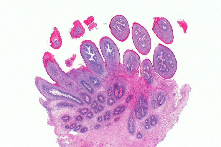 Squamous cell papilloma