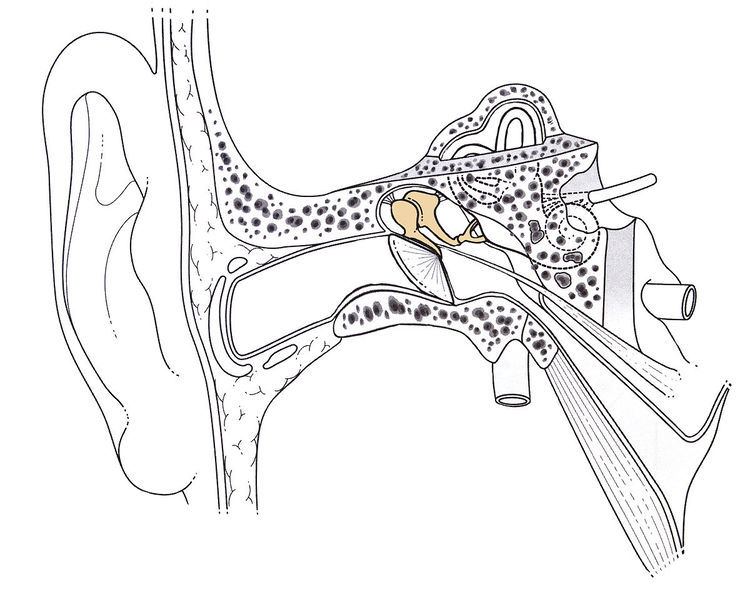 Stapedectomy