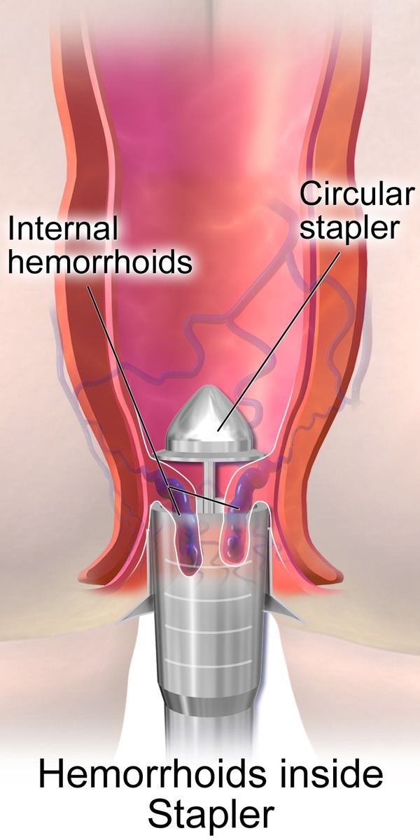 Stapled hemorrhoidopexy