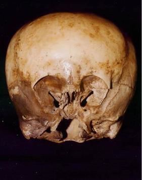 Starchild skull httpsuploadwikimediaorgwikipediaen888Sta