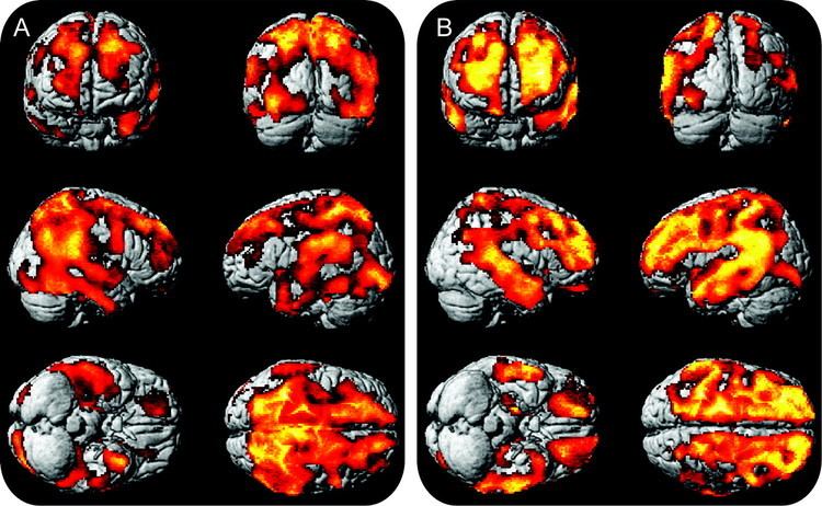 Statistical parametric mapping Early detection of Alzheimer disease