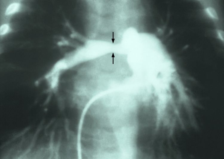 Stenosis of pulmonary artery