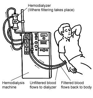 Step-by-step description of hemodialysis