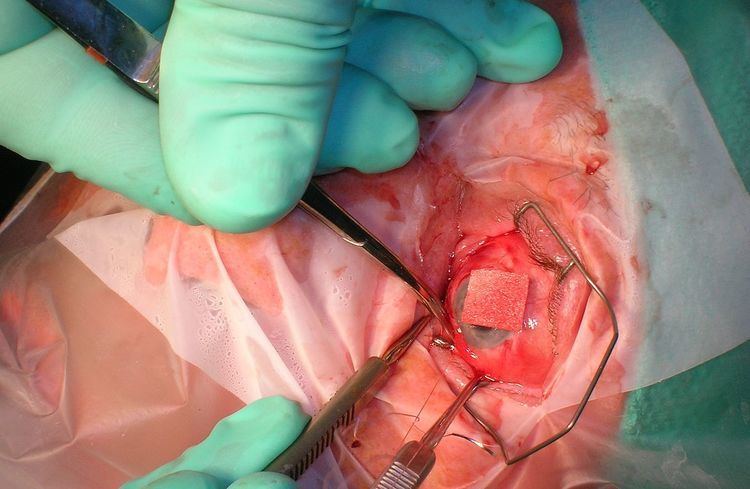 Strabismus surgery