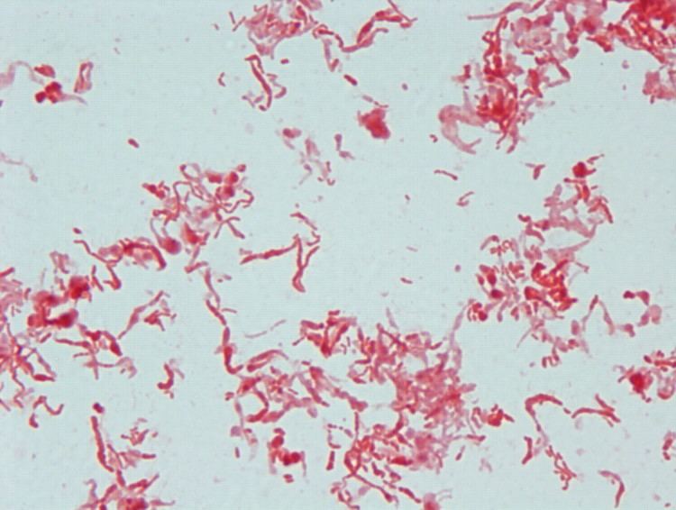 Streptobacillus Epidural Abscess Caused by Streptobacillus moniliformis