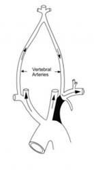 Subclavian steal syndrome