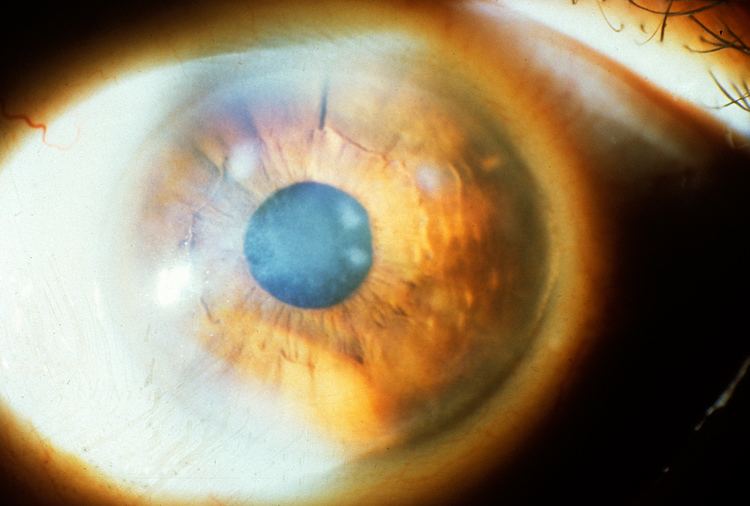 Subepithelial mucinous corneal dystrophy