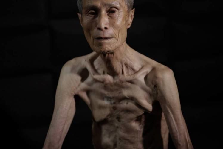 Sumiteru Taniguchi Japanese atomic bomb survivor Sumiteru Taniguchi reveals