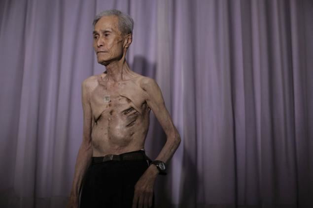 Sumiteru Taniguchi Nagasaki Abomb survivor still suffering NY Daily News