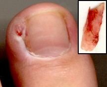 Surgical treatment of ingrown toenails
