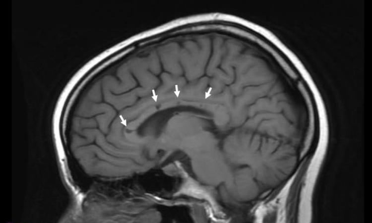 Susac's syndrome