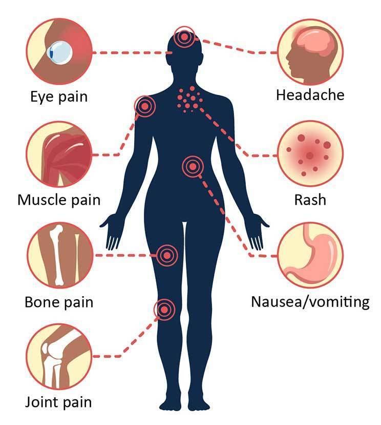 Symptoms and Treatment | Dengue | CDC